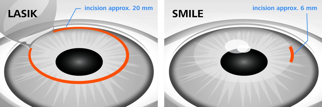 Lazer görme düzeltme yöntemleri LASIK ve SMILE'ın karşılaştırılması